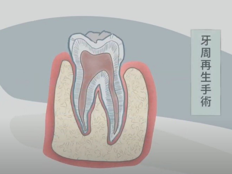 牙周手術治療 牙周手術治療