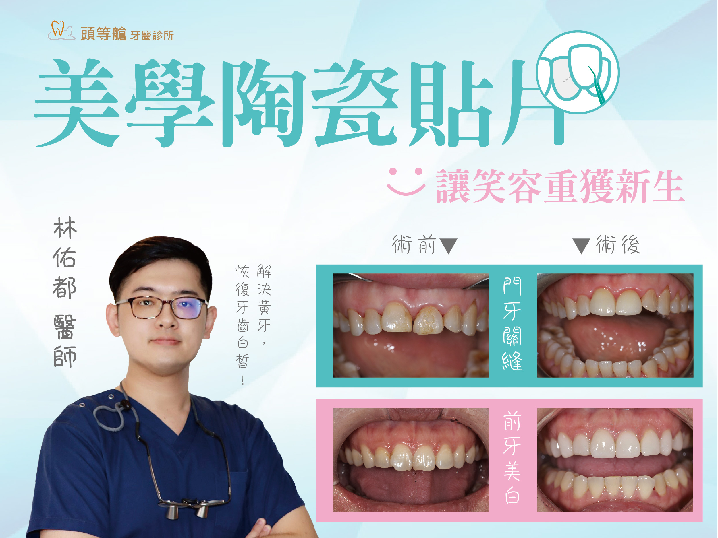 顯微美學陶瓷貼片｜讓笑容重獲新生