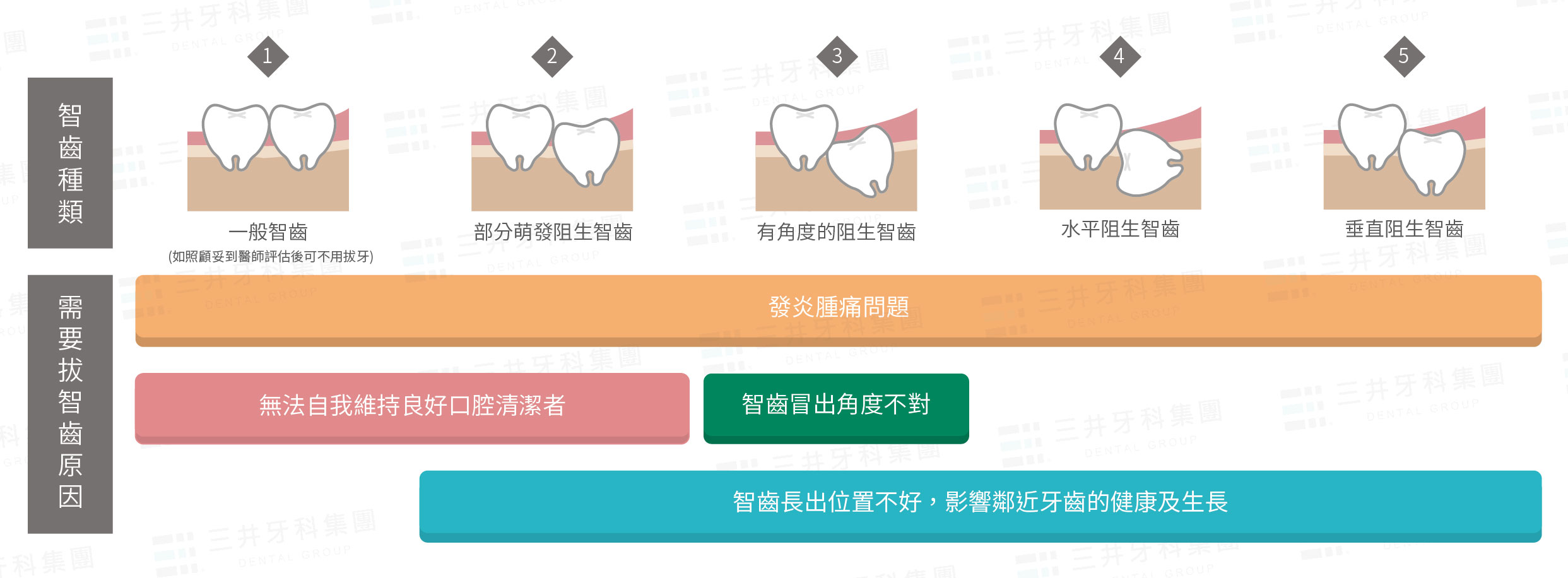拔牙流程報你知，幾步驟讓你跟智齒說掰掰